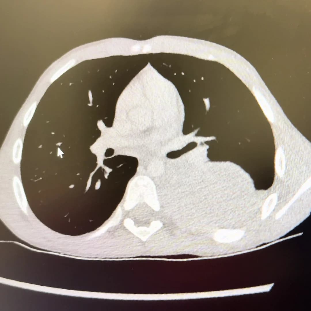 CT scan showing the tumor mass behind Aleks' lung that led to his diagnosis